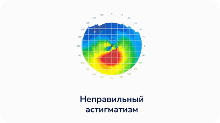 Неправильный астигматизм