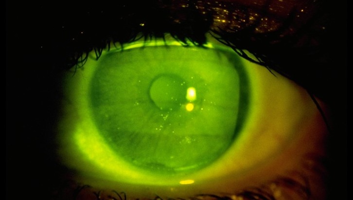 прокрашивание роговицы