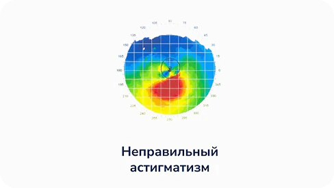 Неправильный астигматизм